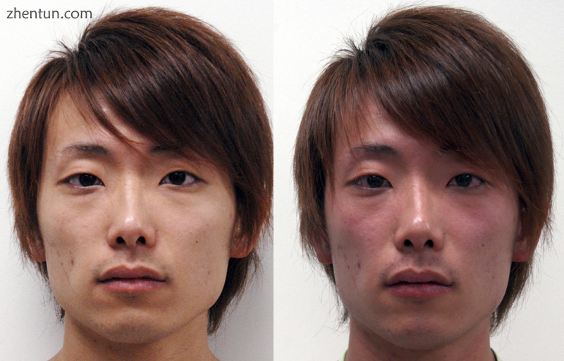 Facial flushing. Before (left) and after (right) drinking alcohol. A 22-year-old.png