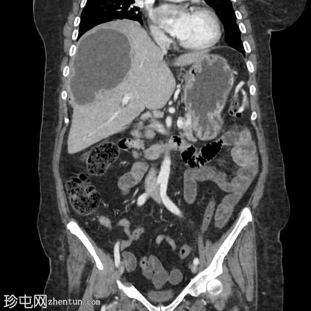 肝脓肿破裂进入胆道，并伴有胆管炎和右肝静脉血栓形成