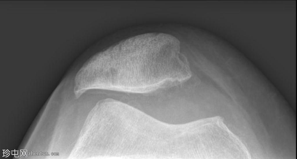 米体-膝关节滑膜软骨瘤病