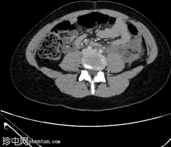 CTPA 诊断肾血管平滑肌脂肪瘤破裂导致胸膜炎性胸痛