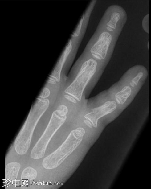 手第五近节指骨骨折
