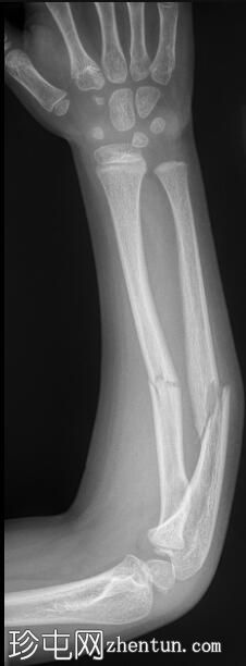 掌侧成角的桡骨和尺骨中段骨折
