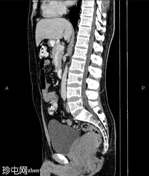 直肠胃肠道间质瘤