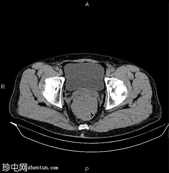 直肠胃肠道间质瘤