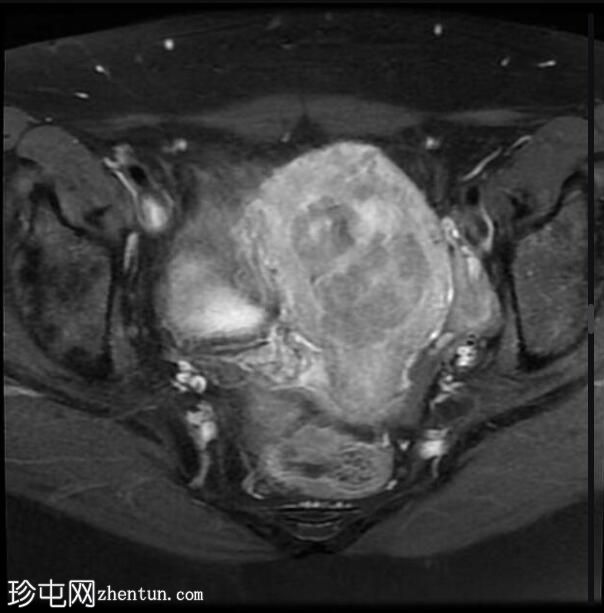 粘膜下子宫肌瘤