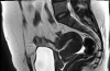 弥漫性子宫腺肌病伴卵巢纤维瘤及剖宫产疤痕憩室