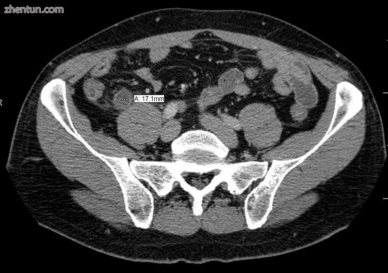 A CT scan demonstrating acute appendicitis (note the appendix has a diameter of 17.1 mm and there is ...