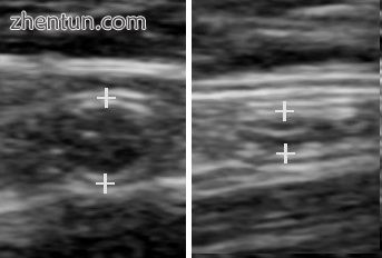 A normal appendix without and with compression. Absence of comprehensibility indicates appendicitis. ...