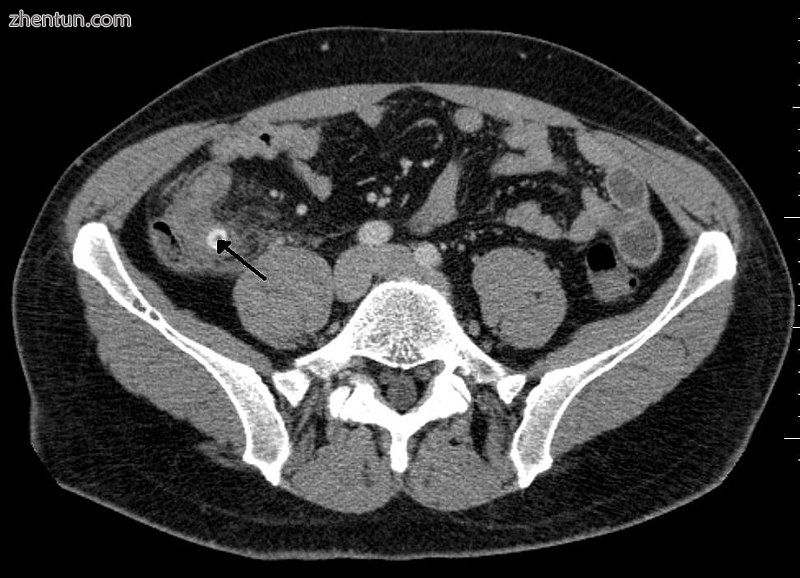 A fecalith marked by the arrow that has resulted in acute appendicitis.