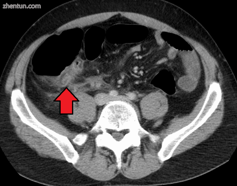 Appendicitis as seen on CT imaging