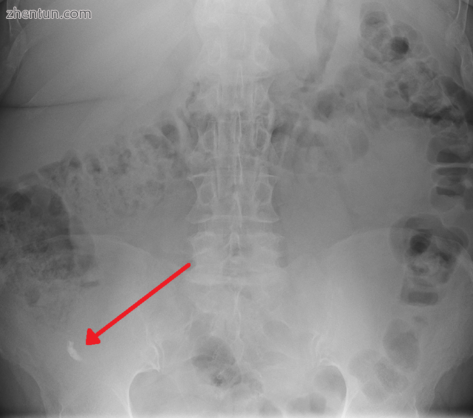 Appendicolith as seen on plain X-ray