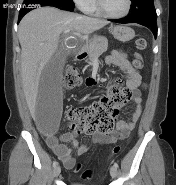 Coronal CT scan of a person initially suspected of having appendicitis because of right-sided pain.  ...