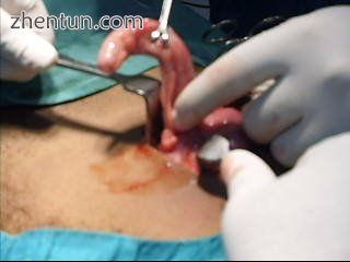 Inflamed appendix removal by open surgery