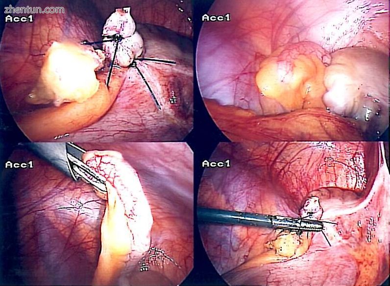Laparoscopic appendectomy.