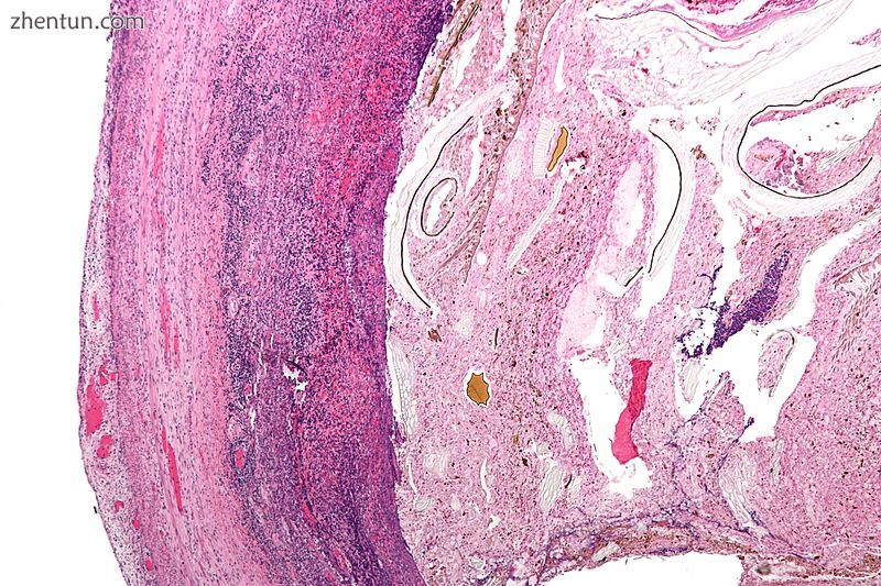 Micrograph of appendicitis and periappendicitis. H&E stain.