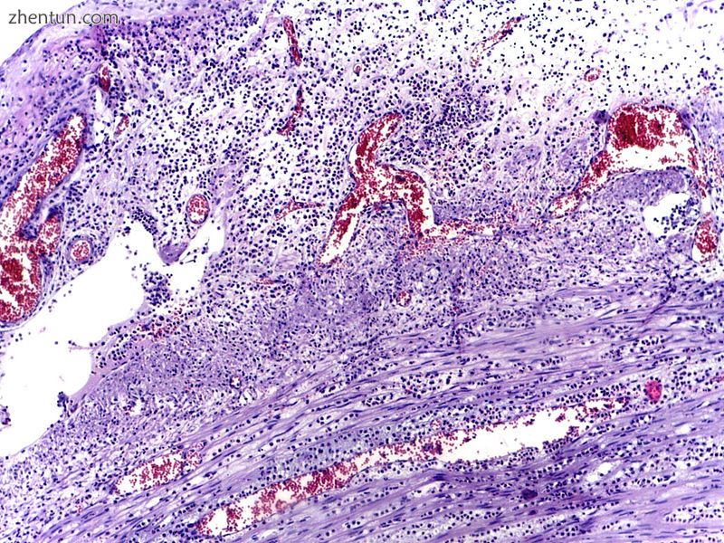 Micrograph of appendicitis showing neutrophils in the muscularis propria. H&E stain.