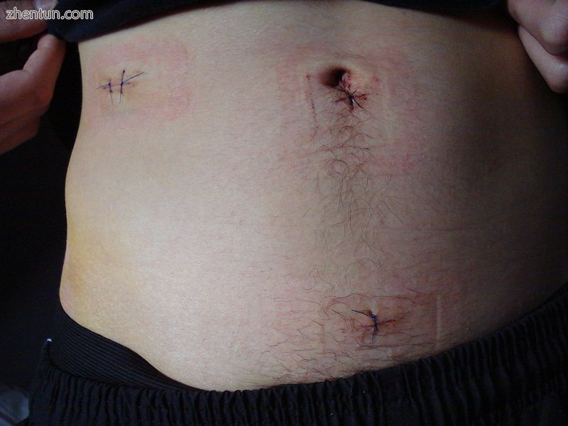  The stitches the day after having the appendix removed by laparoscopic surgery
