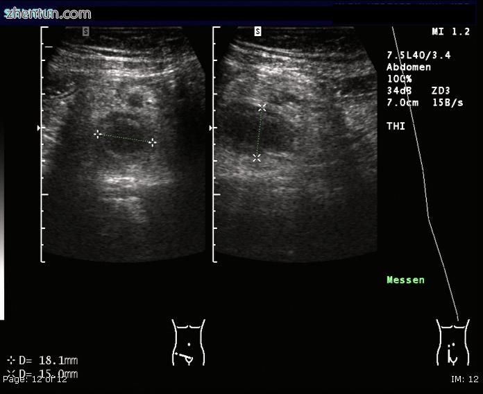 Ultrasound image of acute appendicitis