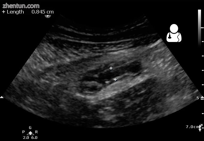 Ultrasound showing appendicitis and an appendicolith[48]
