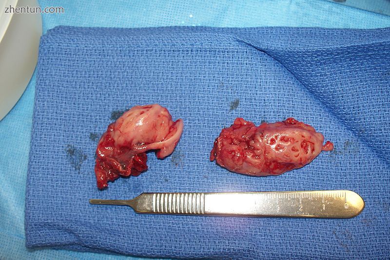 Cryptic tonsils immediately following surgical removal (bilateral tonsillectomy).