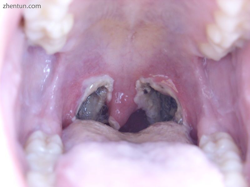 Throat 1 day after a tonsillectomy.