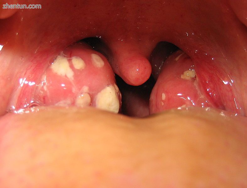 Throat with tonsilloliths.