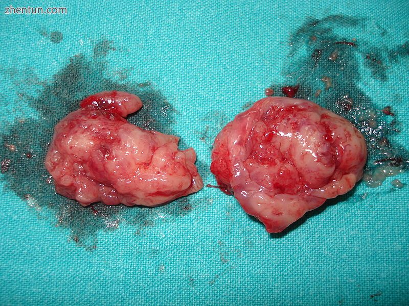 Two removed tonsils.