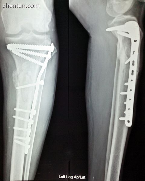 Anterior and lateral view x-rays of fractured left leg with internal fixation after surgery