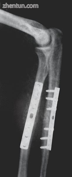 Orthopedic implants to repair fractures to the radius and ulna. Note the visible break in the ulna.  ...