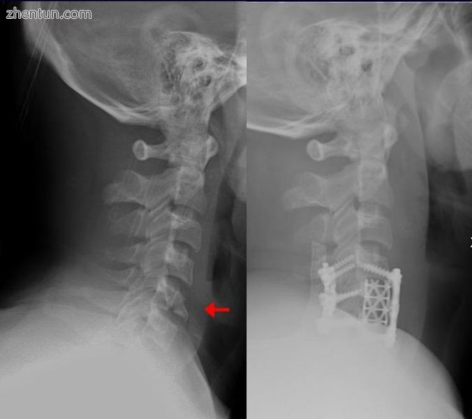 This fracture of the lower cervical vertebrae is one of the conditions treated by orthopedic surgeon ...