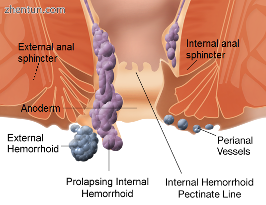 Hemorrhoids.png