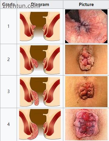 Internal hemorrhoid grades