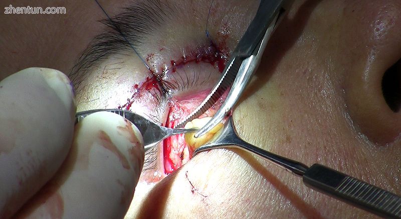 Fat is removed from the lower eyelid by means of an incision to the inner surfac.jpg