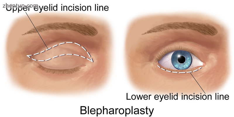 Illustration depicting incision lines for blepharoplasty