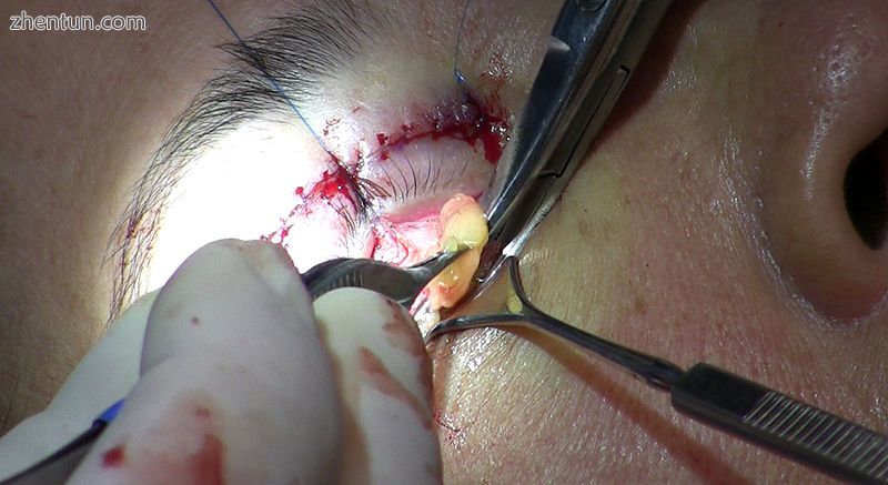 The fat is excised (cut away) with surgical scissors..jpg
