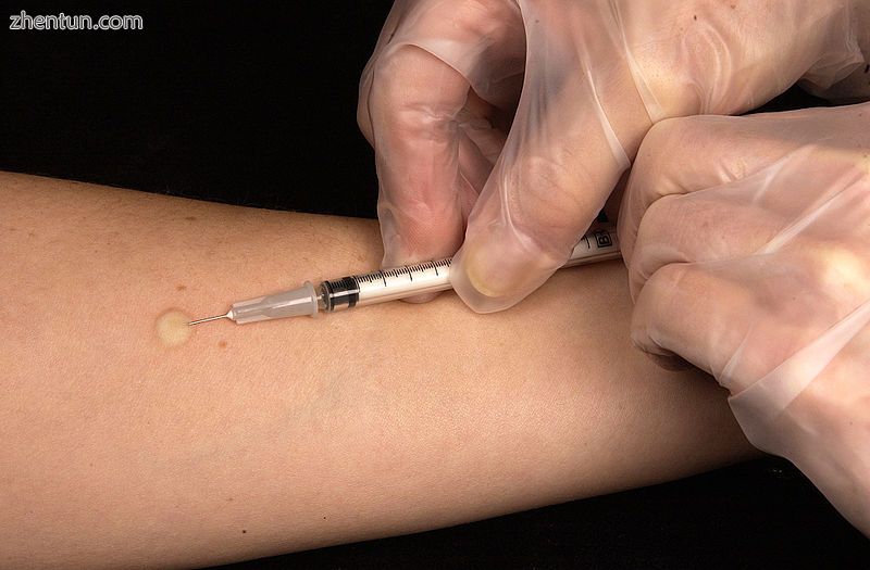 Mantoux tuberculin skin test