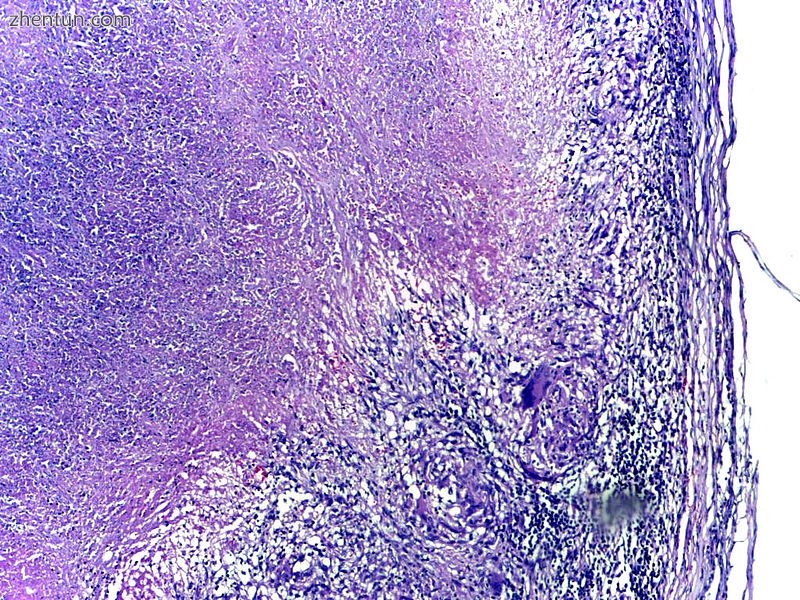 Microscopy of tuberculous epididymitis. H&E stain