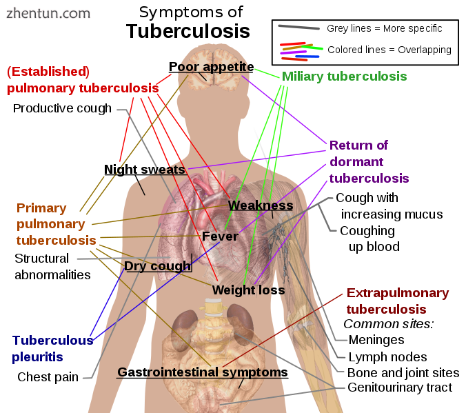 The main symptoms of variants and stages of tuberculosis are given