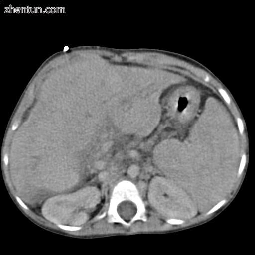 Liver cirrhosis as seen on a CT of the abdomen in transverse orientation