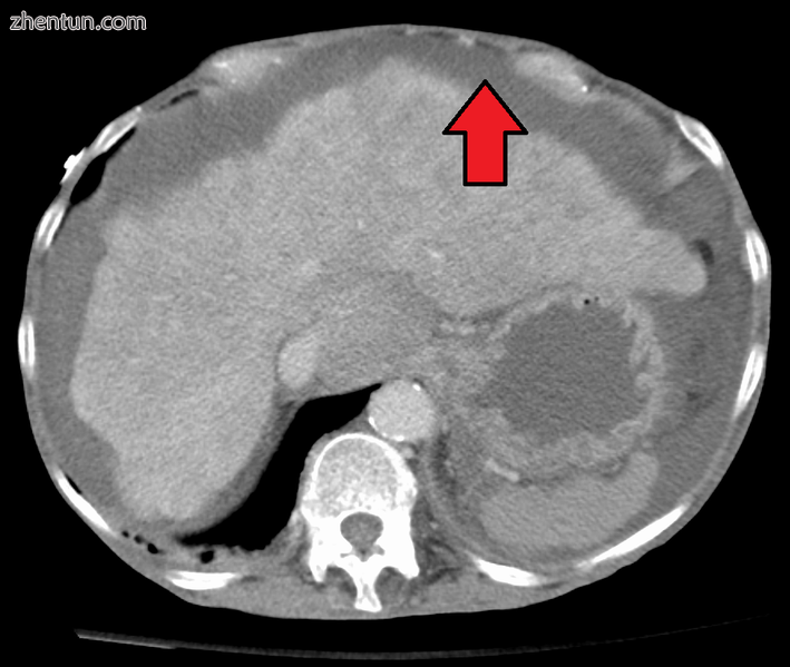 Liver cirrhosis with ascites