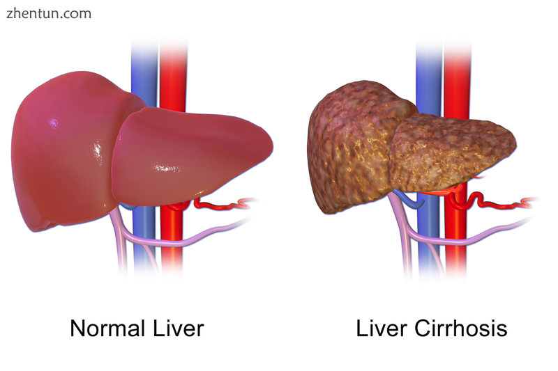 Liver cirrhosis.