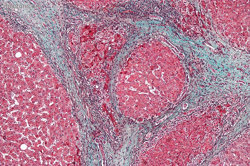 Micrograph showing cirrhosis. Trichrome stain.