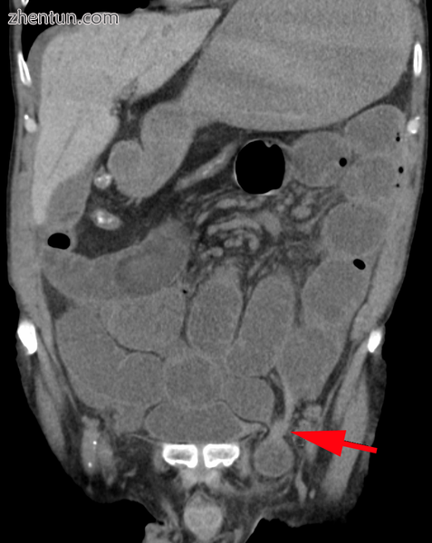 A frontal view of an incarcerated inguinal hernia (on the patient's left side) with dilated loops of ...