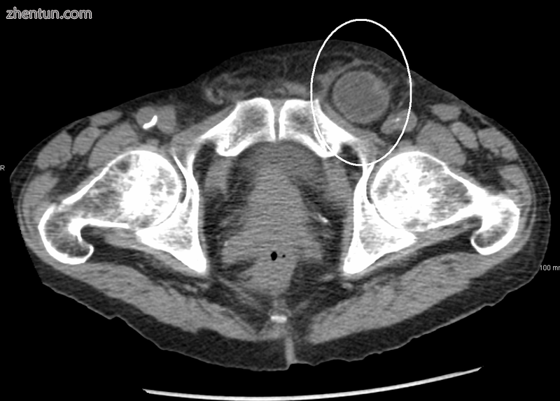 An incarcerated inguinal hernia as seen on cross sectional CT scan