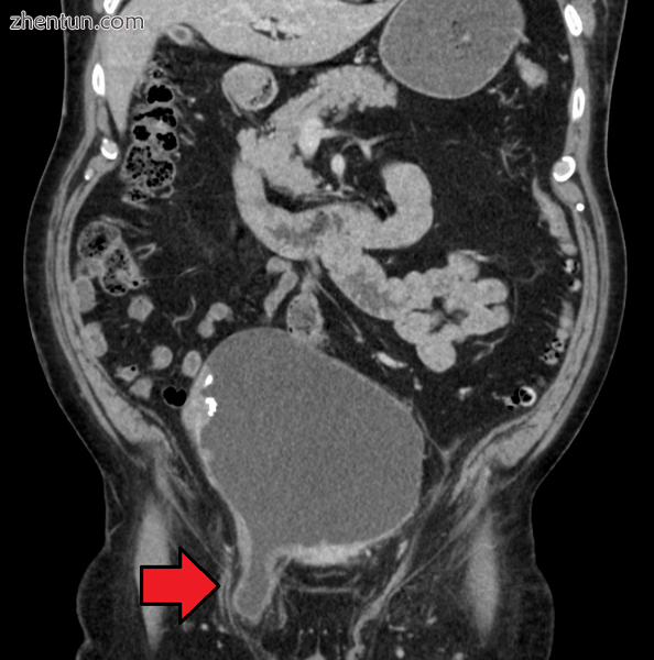 An inguinal hernia which contains part of the bladder. Bladder cancer also present.