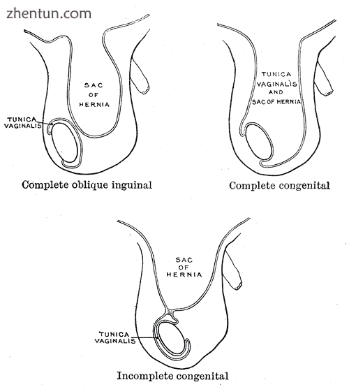 Different types of inguinal hernias.