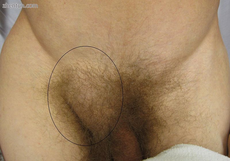 Frontal view of an inguinal hernia (right).