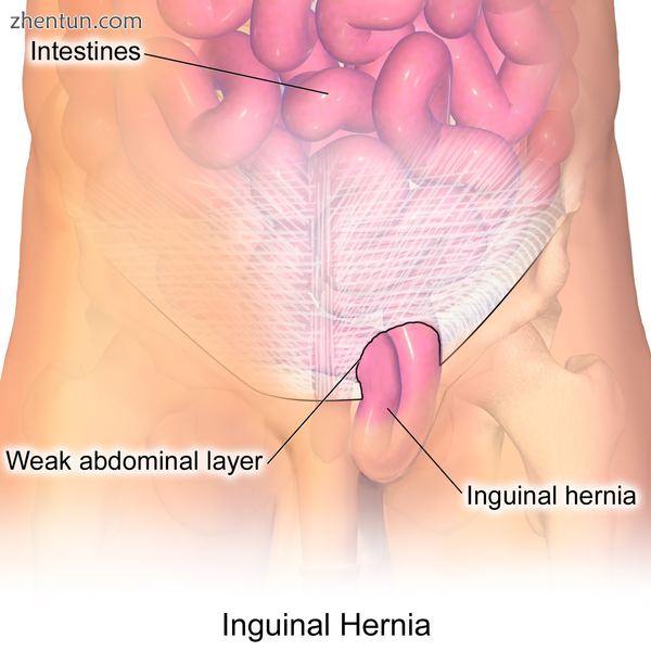 Illustration of an inguinal hernia.