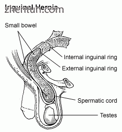 Inguinal hernia