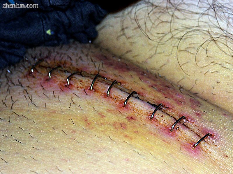 Surgical incision in groin after inguinal hernia operation.jpg